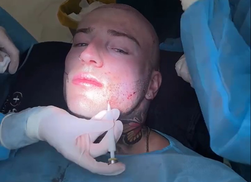 George Irving Hair & Beard Transplant