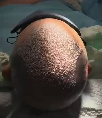 robotic DHI hair grafts