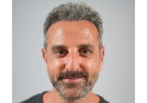 Karim’s Robotic Hair Transplant