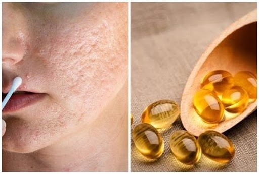 cach-tri-seo-bang-vitamin-e (2)