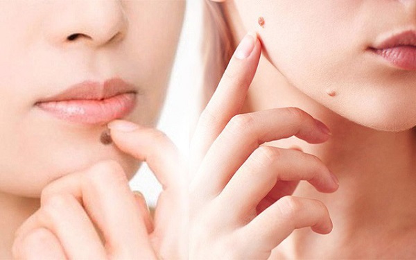 Cách điều trị sẹo thâm sau khi tẩy nốt ruồi hiệu quả ngay tại nhà