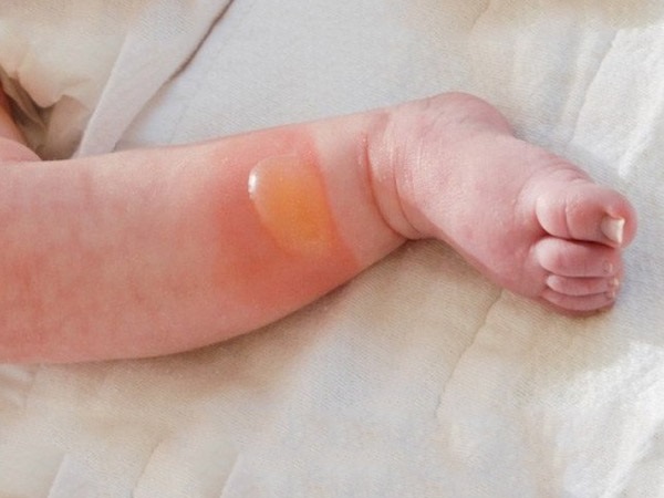 Cách dùng kem thuốc trị sẹo cho bé khi bé bị bỏng