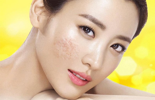 Các cách chữa sẹo lõm tại nhà hiệu quả bất ngờ