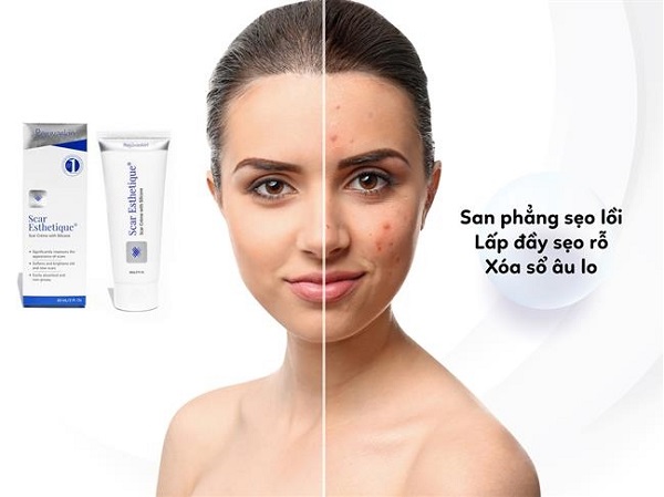 Các cách chữa sẹo lõm tại nhà hiệu quả bất ngờ