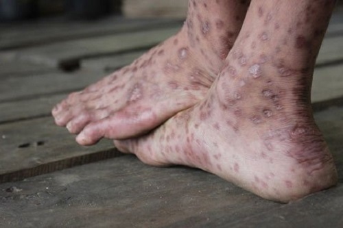 Cách trị sẹo ghẻ lâu năm ở chân