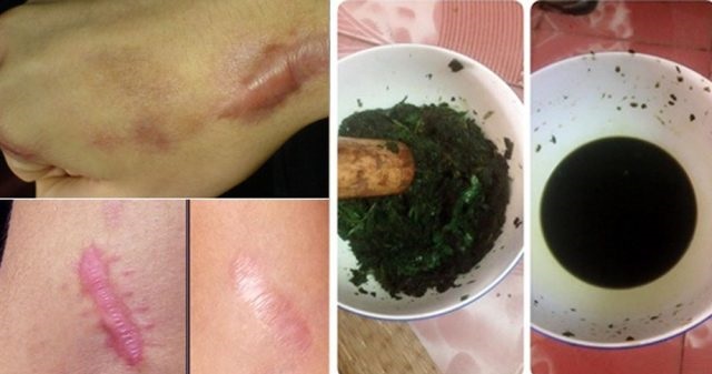 Các cách trị sẹo ngứa lâu năm ở chân 