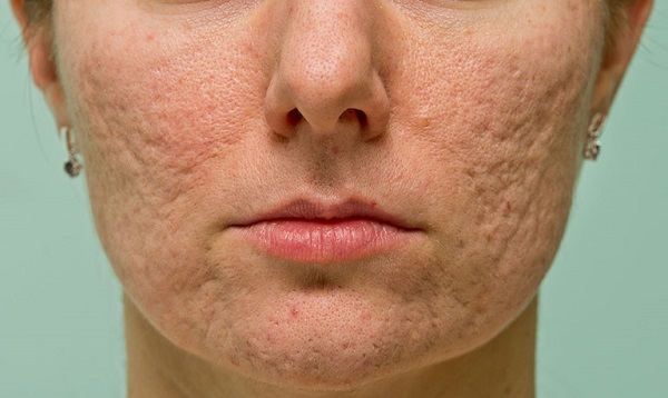 Điều trị sẹo rỗ hết bao nhiêu tiền