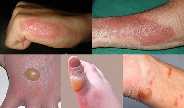 Những cách chữa sẹo bỏng nước sôi từ thiên nhiên