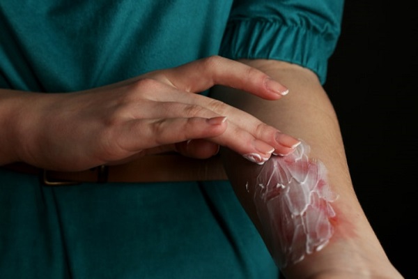 Những cách chữa sẹo bỏng nước sôi từ thiên nhiên