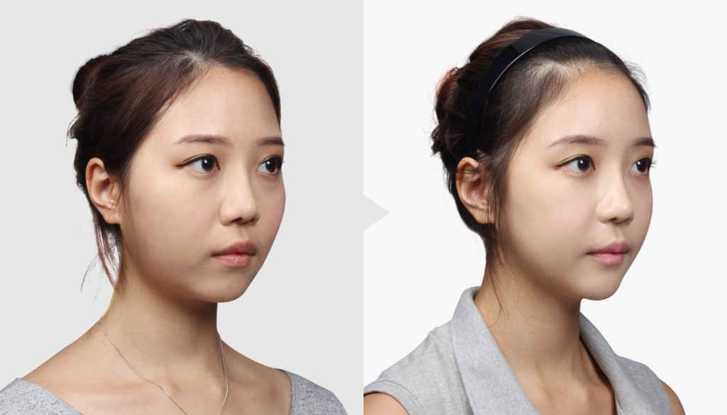 ưu điểm của cấy mỡ thái dương