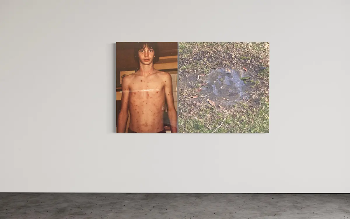 Chicken pox and puddle