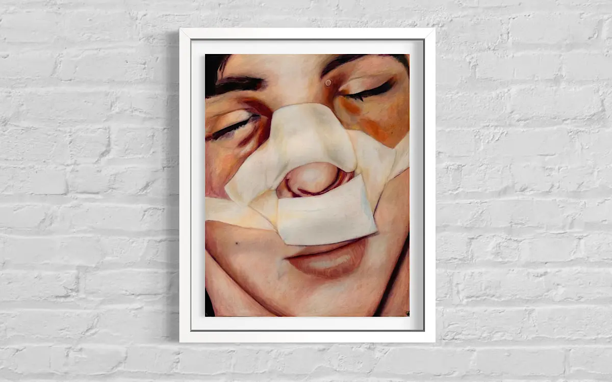 Alt text: A portrait painting of a person after a nose operation, leaving the face, black and blue around the eye, swollen nose, and bandage around the nose and face. 