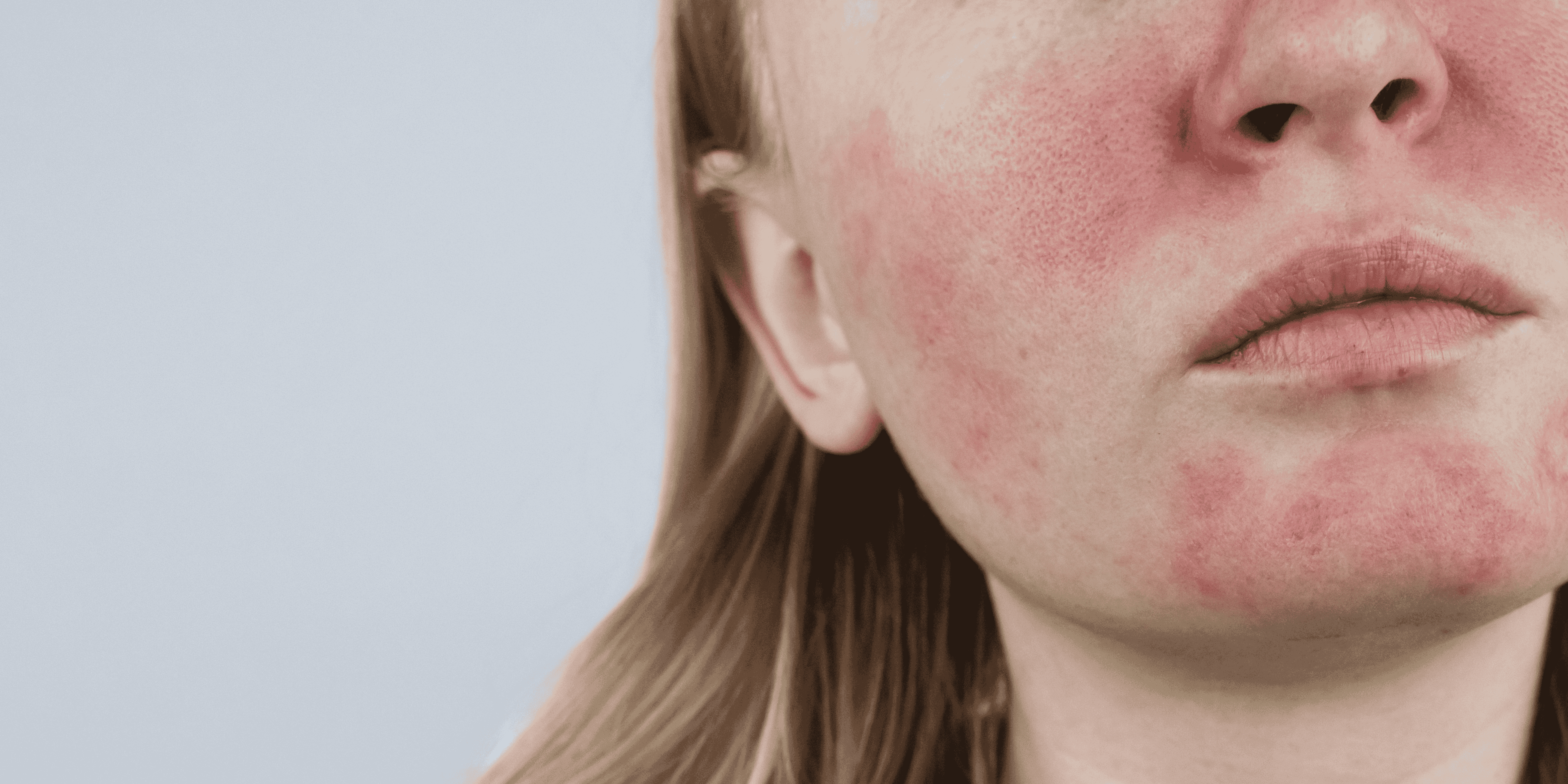Rožinė rosacea paraudimas bėrimai simtomai veido odoje