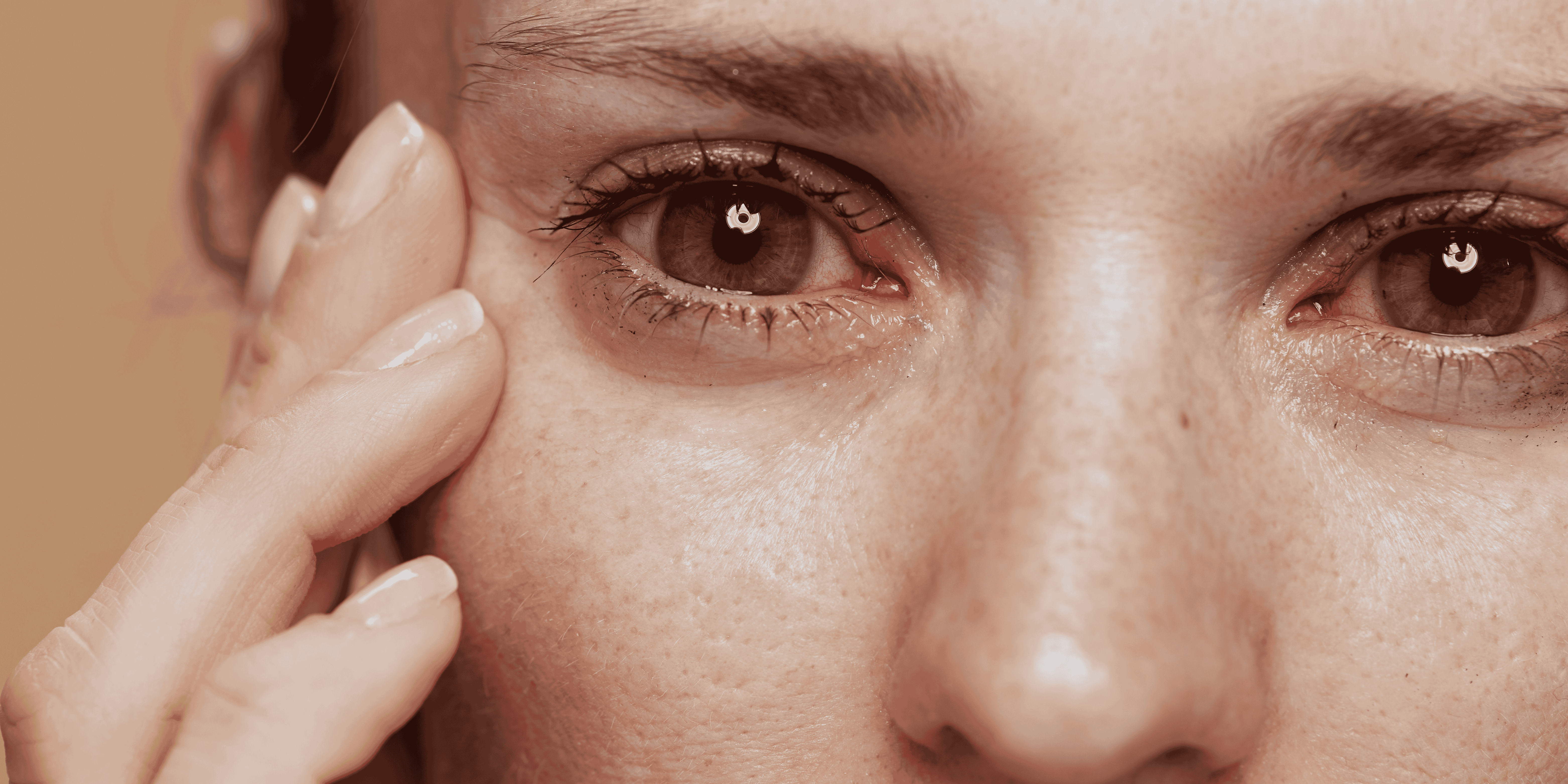 rožinė raudonos akys ocular rosacea