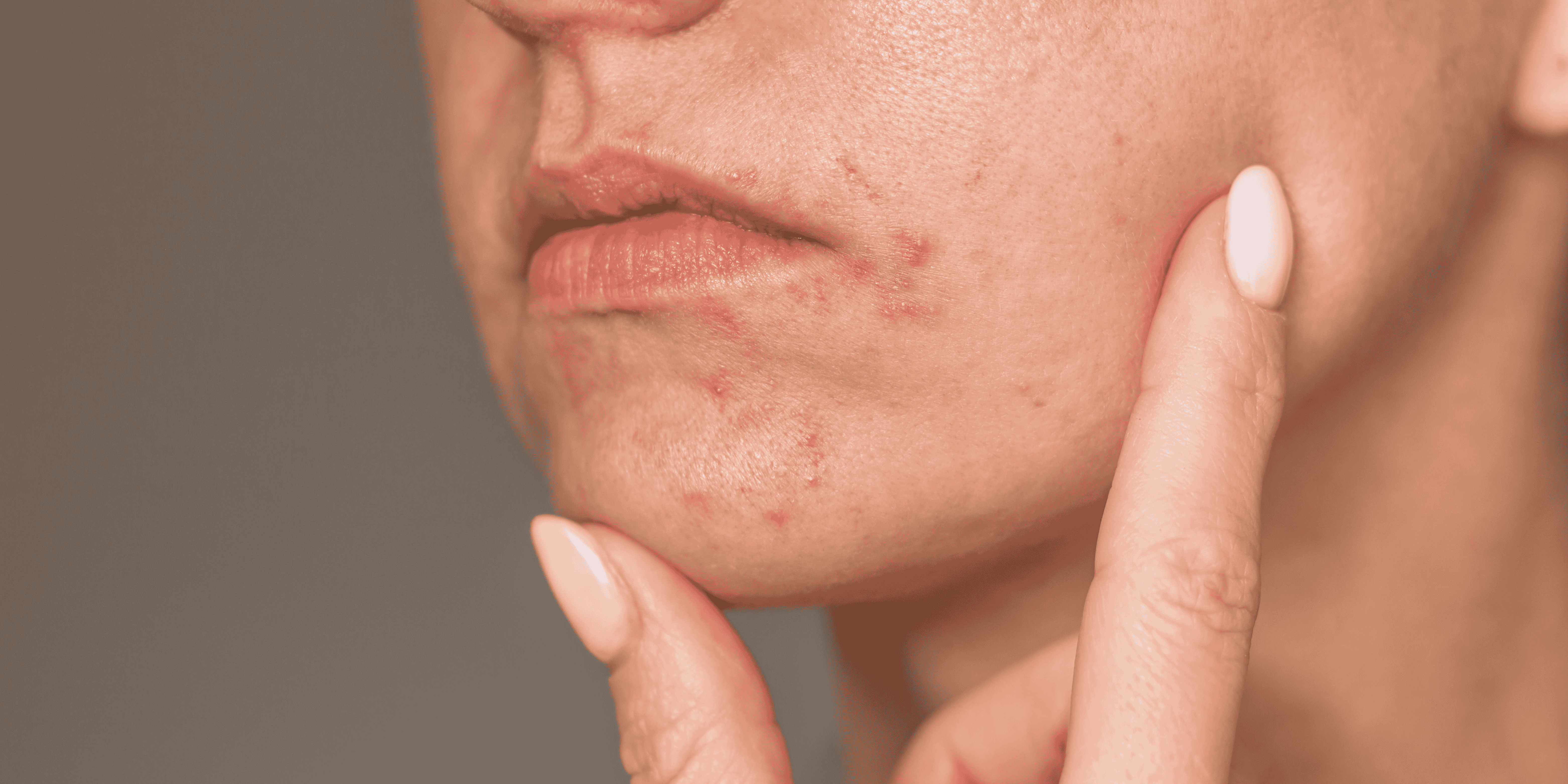 perioralinis  dermatitas bėrimai paraudimas pleiskanojimas deginimas perštėjimas