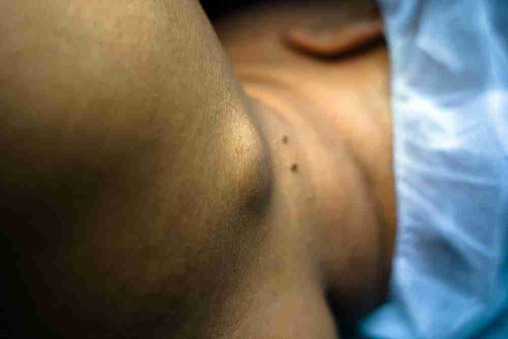 Tumours That Shouldn't Have You Worried
