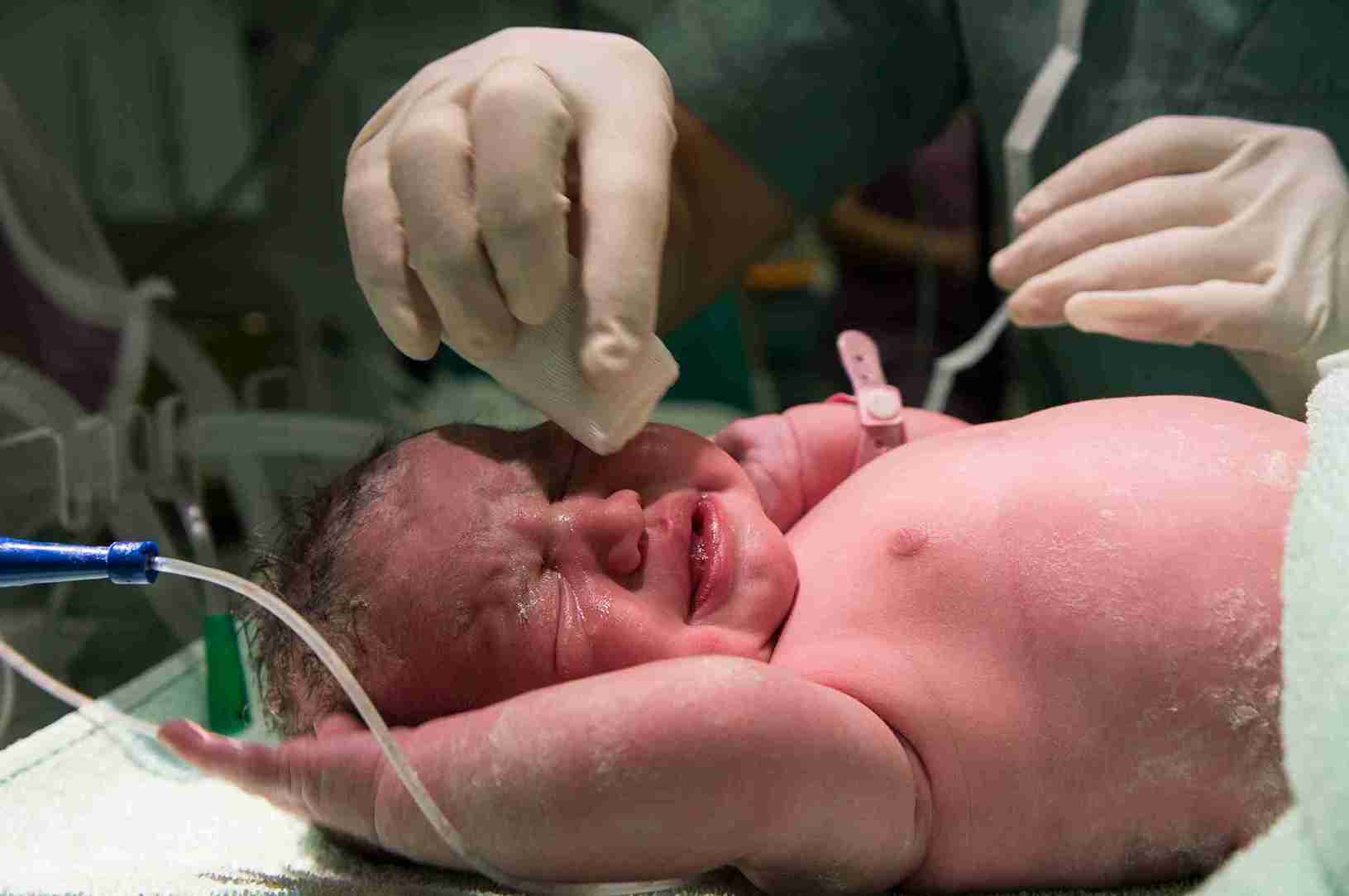 Diagnosing Congenital Rubella Syndrome