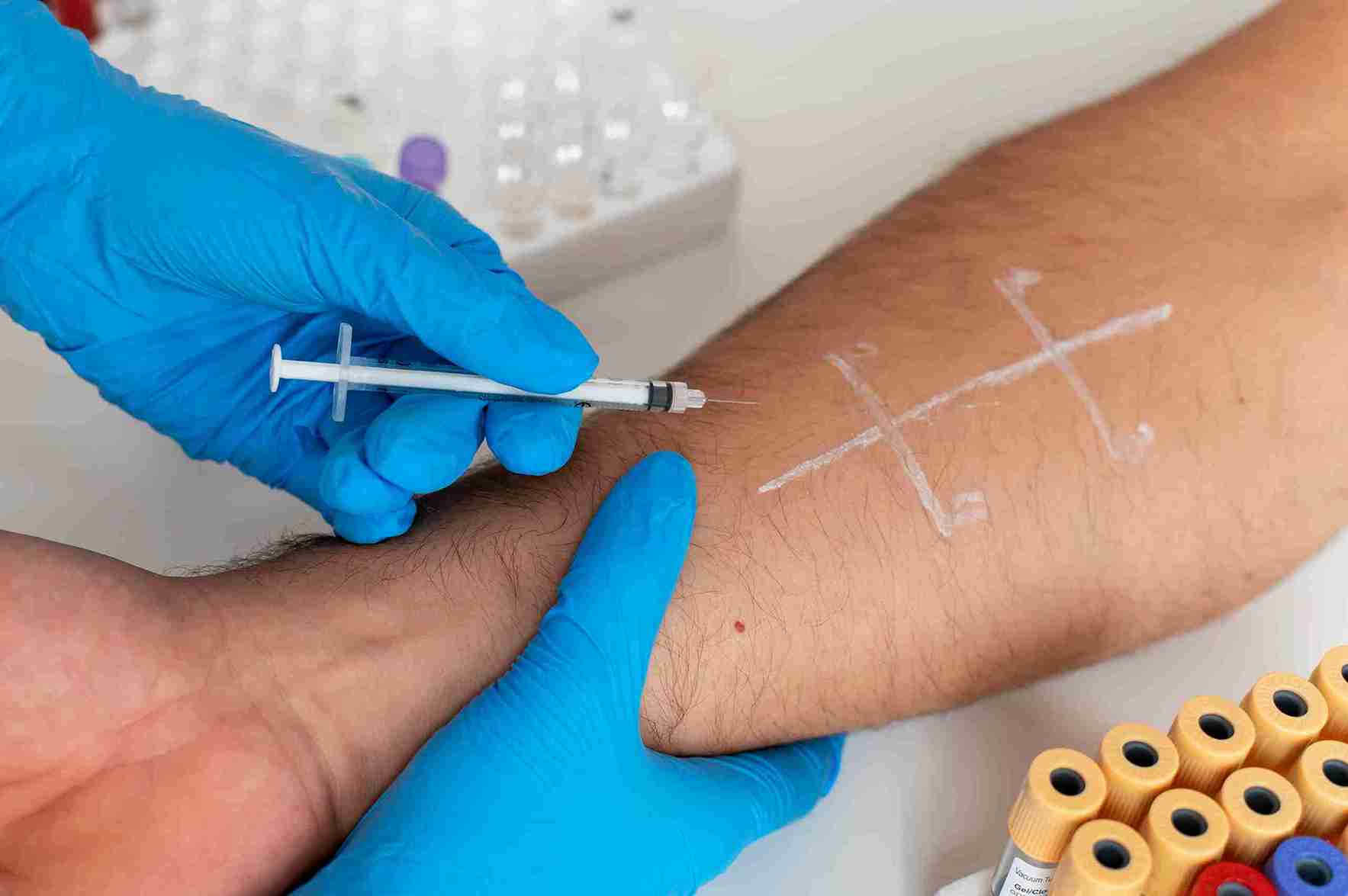 Mantoux Tuberculin Skin