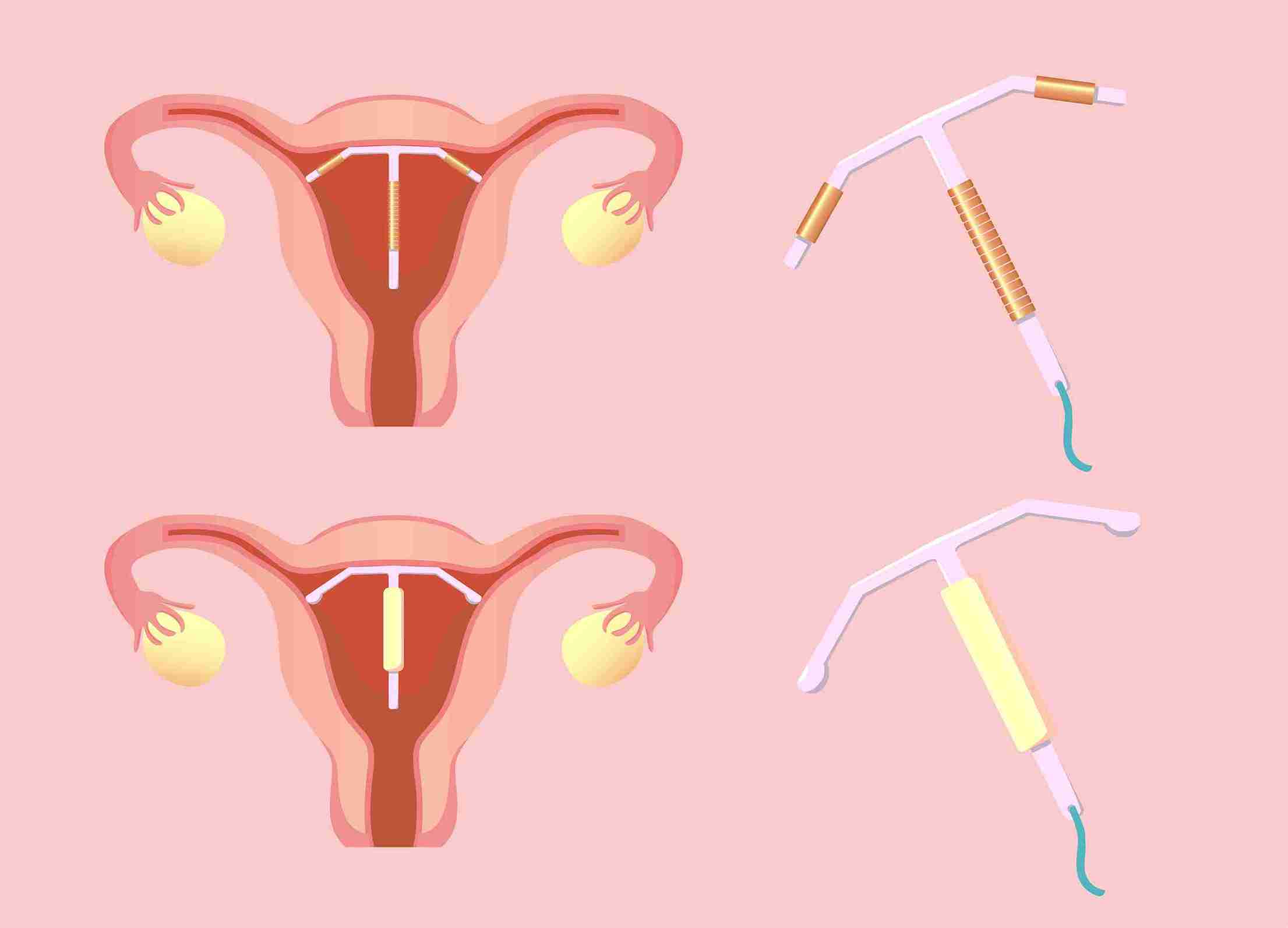 How Does Mirena Help With Endometriosis