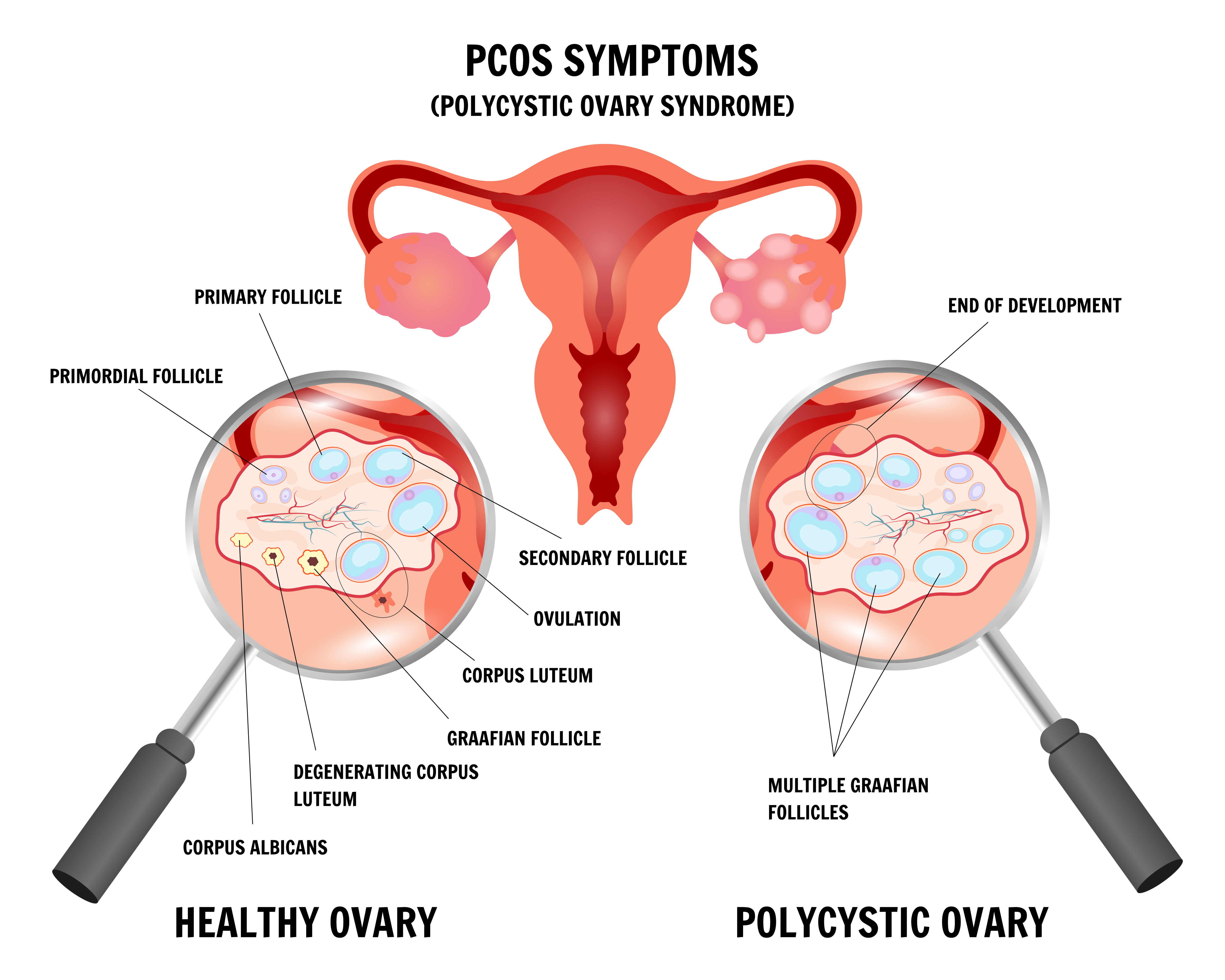 PCOS, या पॉलीसिस्टिक ओवरी सिंड्रोम, एक हार्मोनल और मेटाबोलिक डिसऑर्डर है