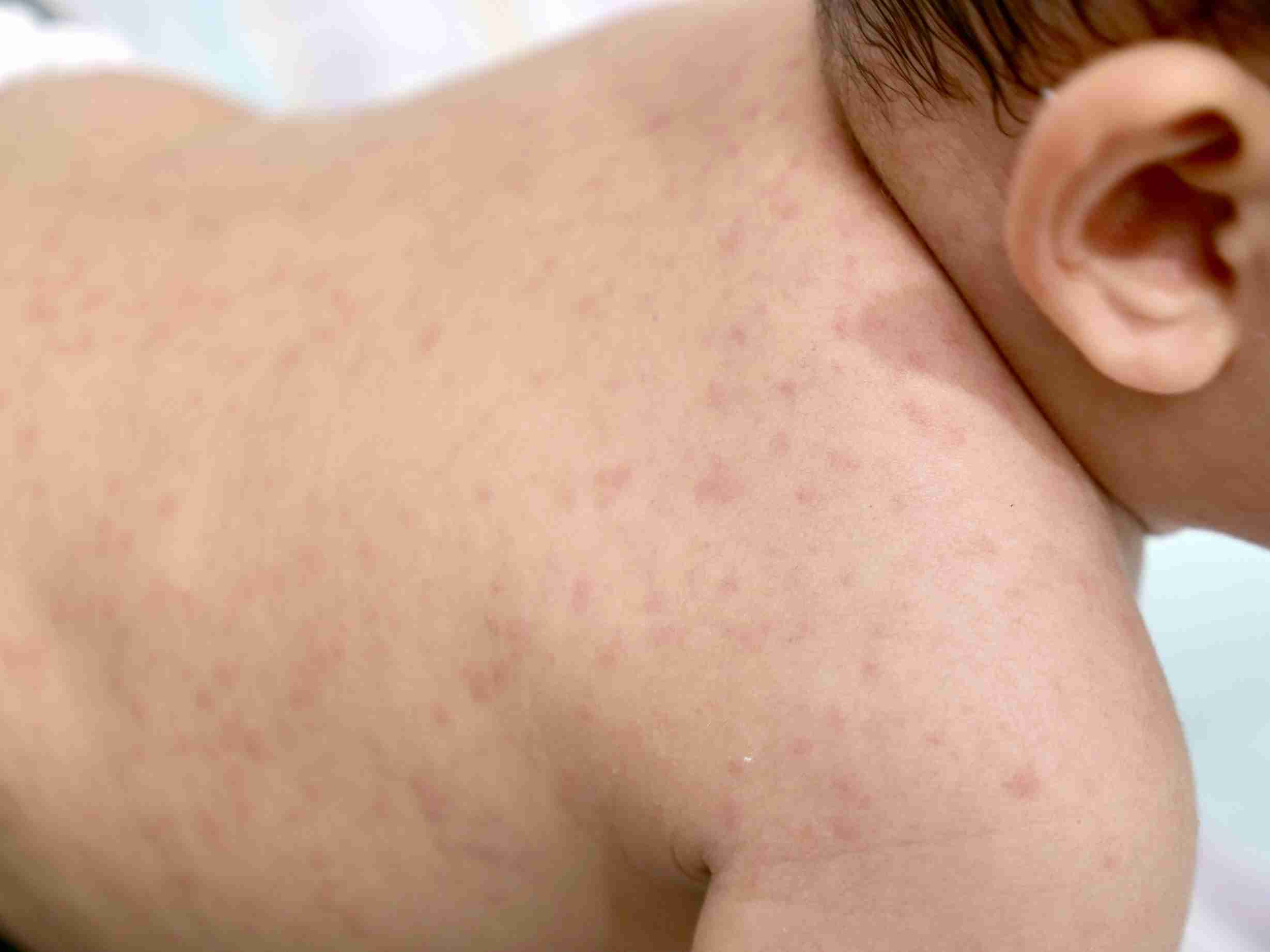 Baby acne appears as small red or white pimples,