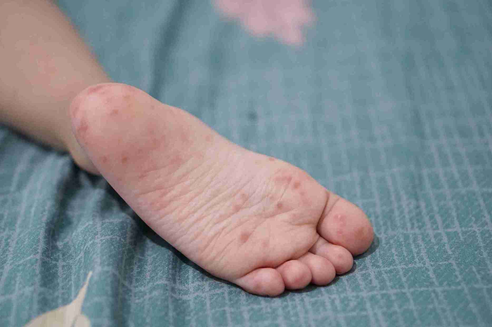 हाथ, पैर और मुंह रोग (HFMD) के लक्षण