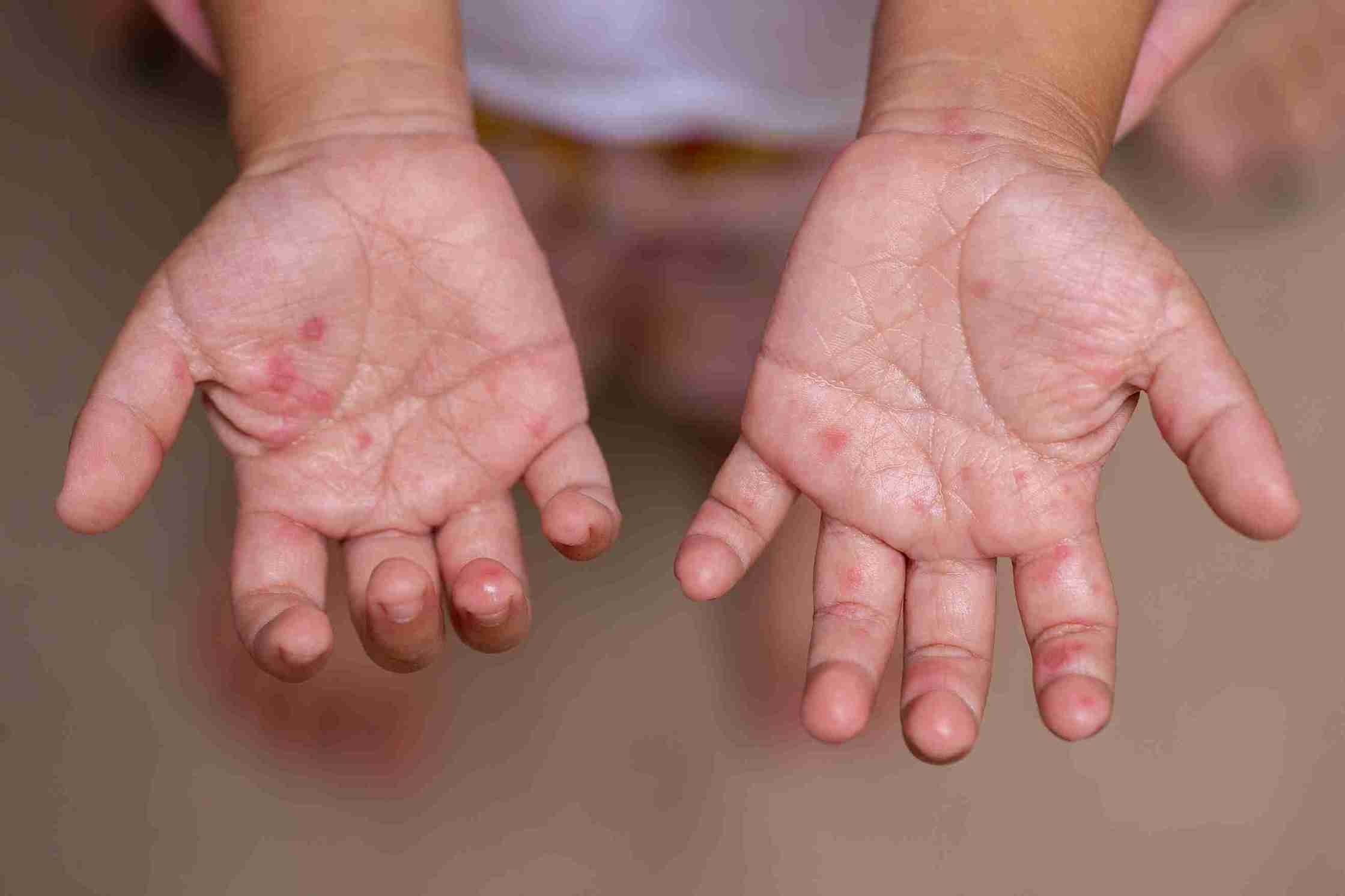 Hand, Foot and Mouth Disease (HFMD)