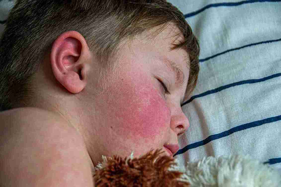 Prickly heat (miliaria) is extremely common in children during summer and in hot