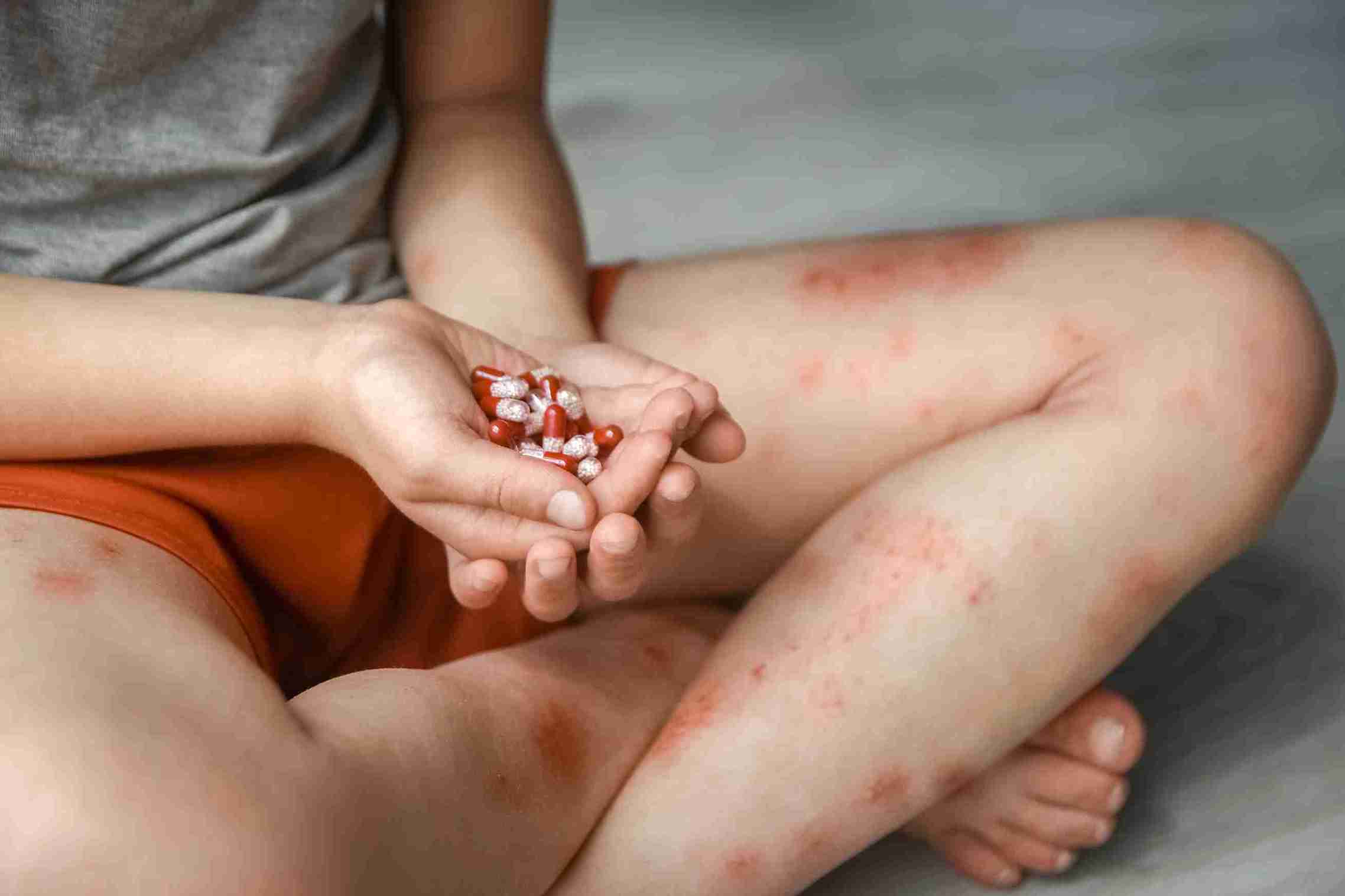 Ringworm (tinea) is not a worm at all, but a fungal infection that causes a circular, scaly