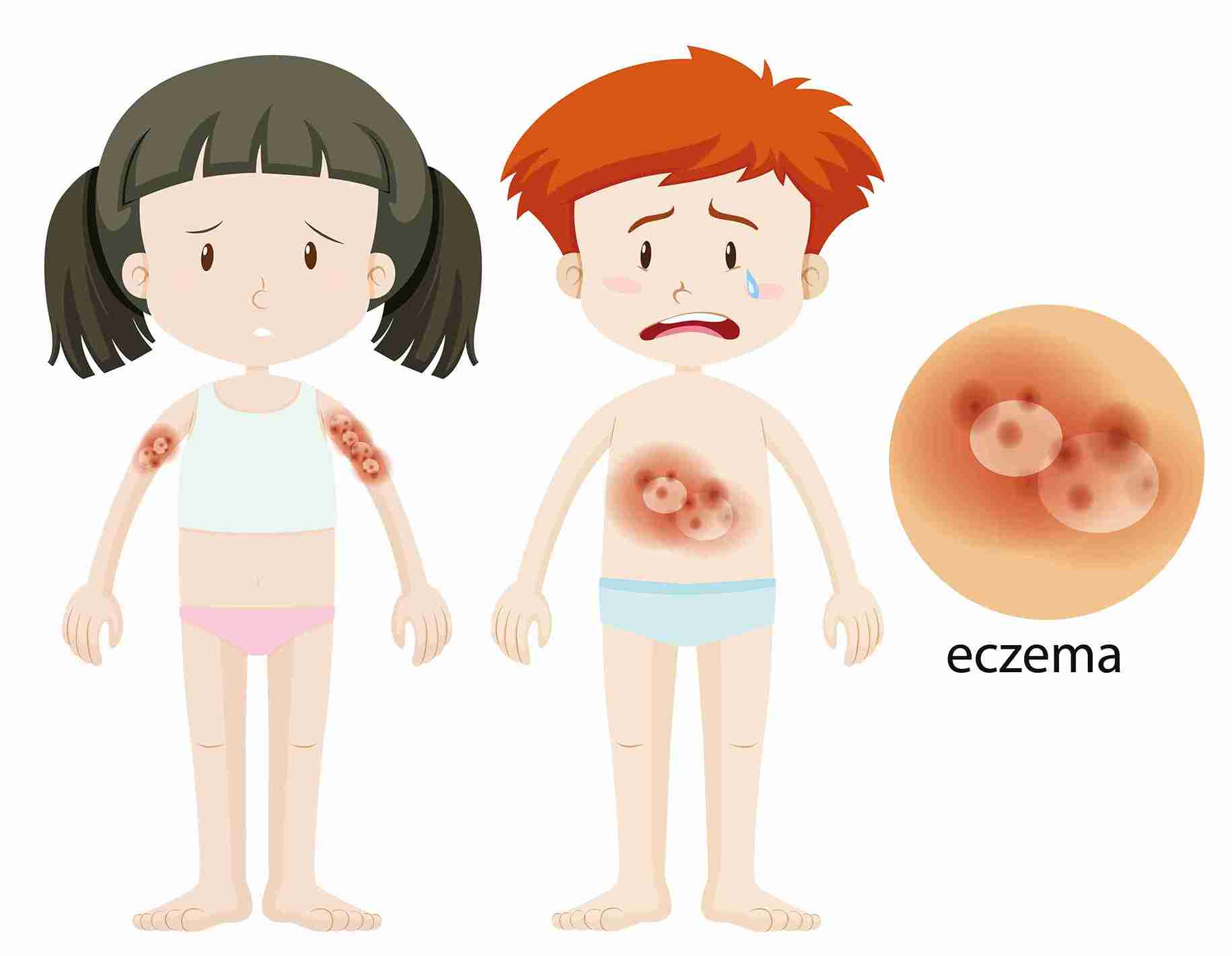 Eczema is a skin condition that affects a significant number of children