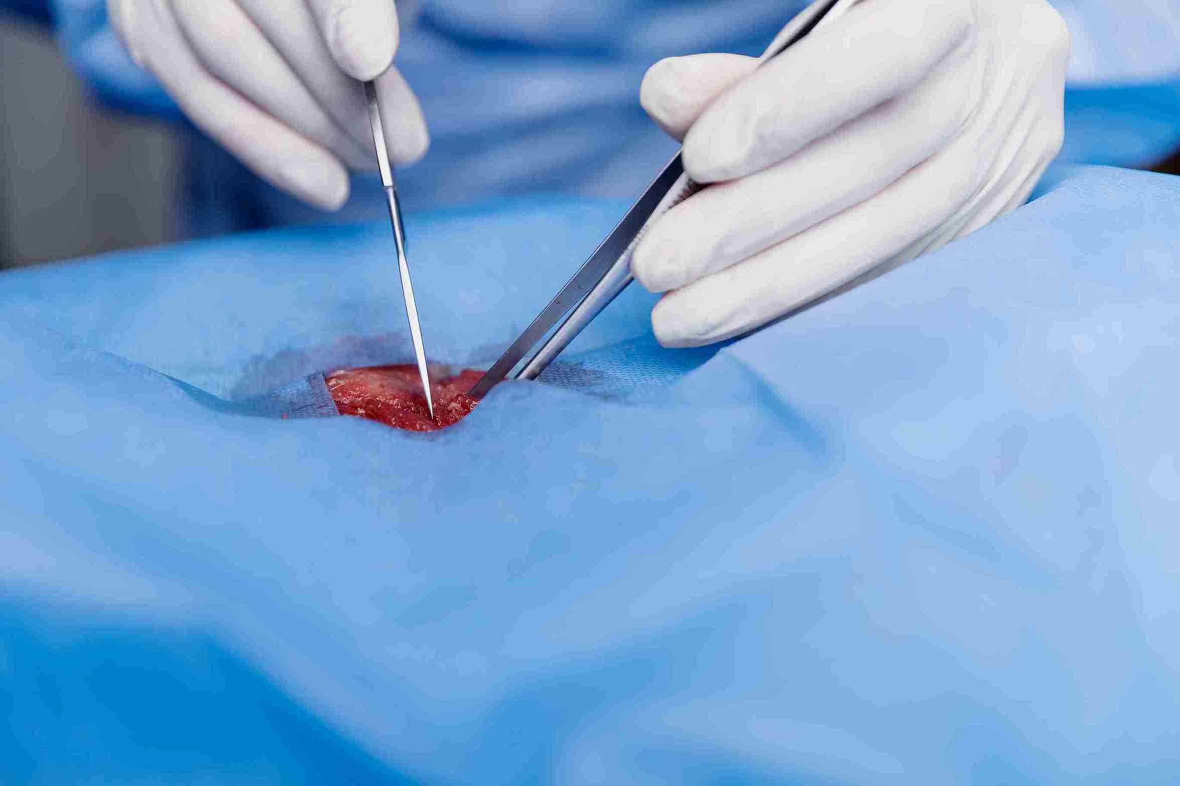 removal of polyps or submucosal fibroids