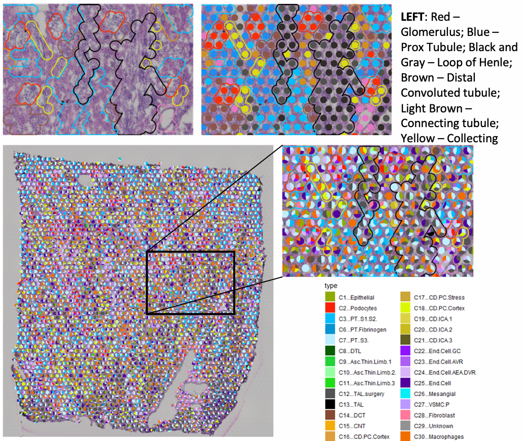 snRNAseq clusters mapped onto a nephrectomy specimen. In each spot, the proportion of signature arising from each cell type is determined