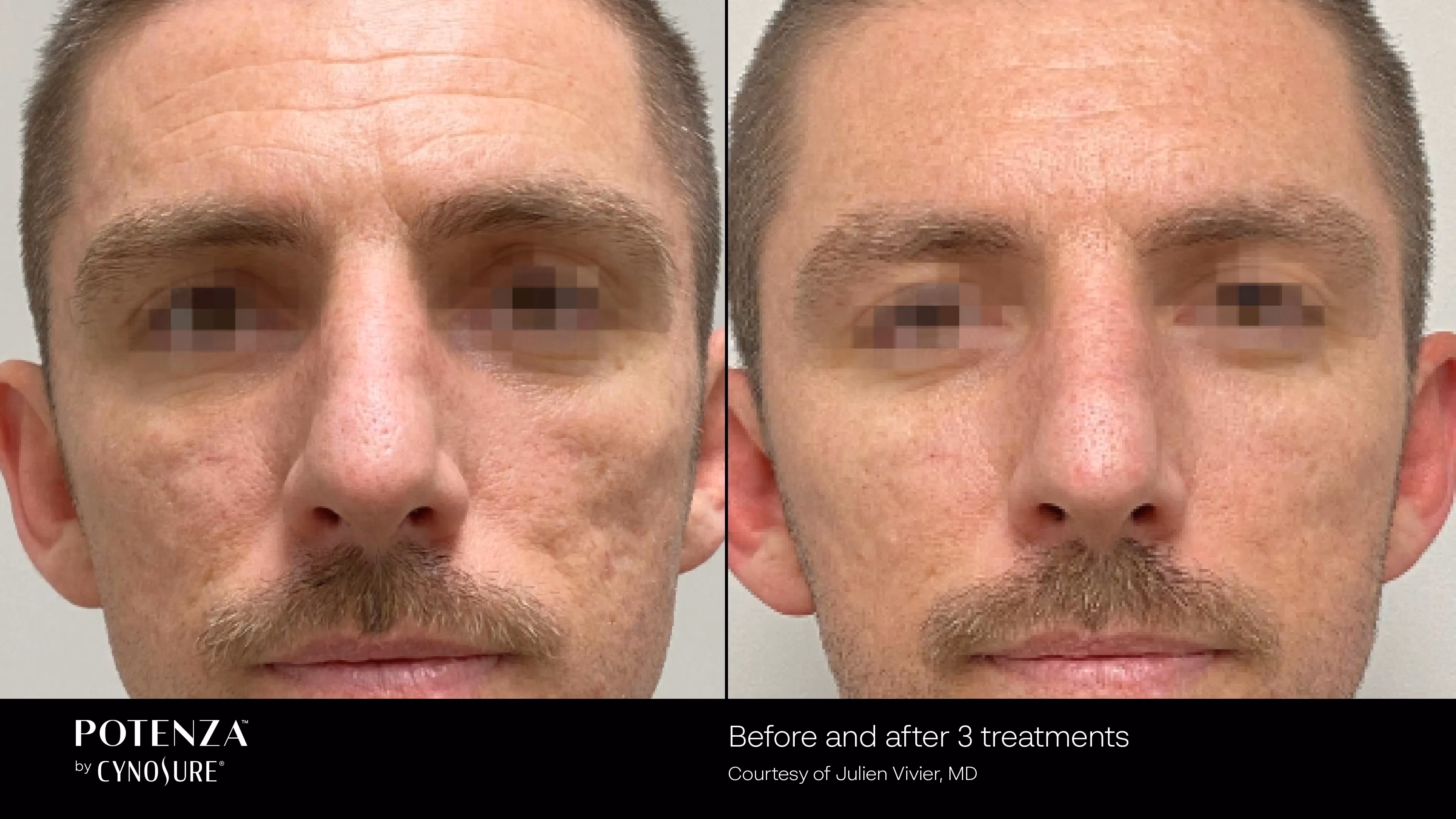 Before-and-after photos showing improved skin texture after three professional skin rejuvenation treatments