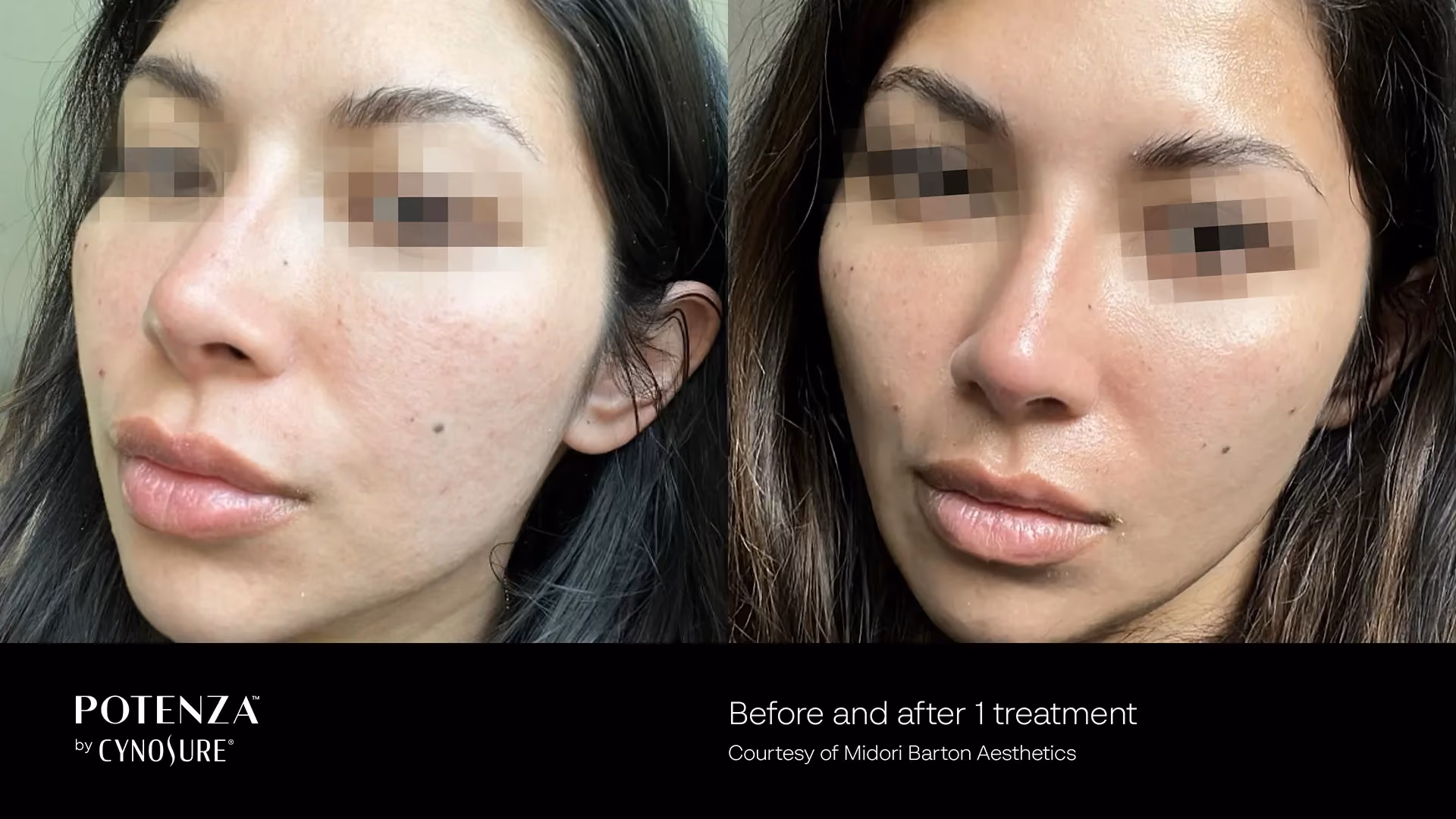 Before-and-after photos showing smoother, brighter skin after one professional skin rejuvenation treatment