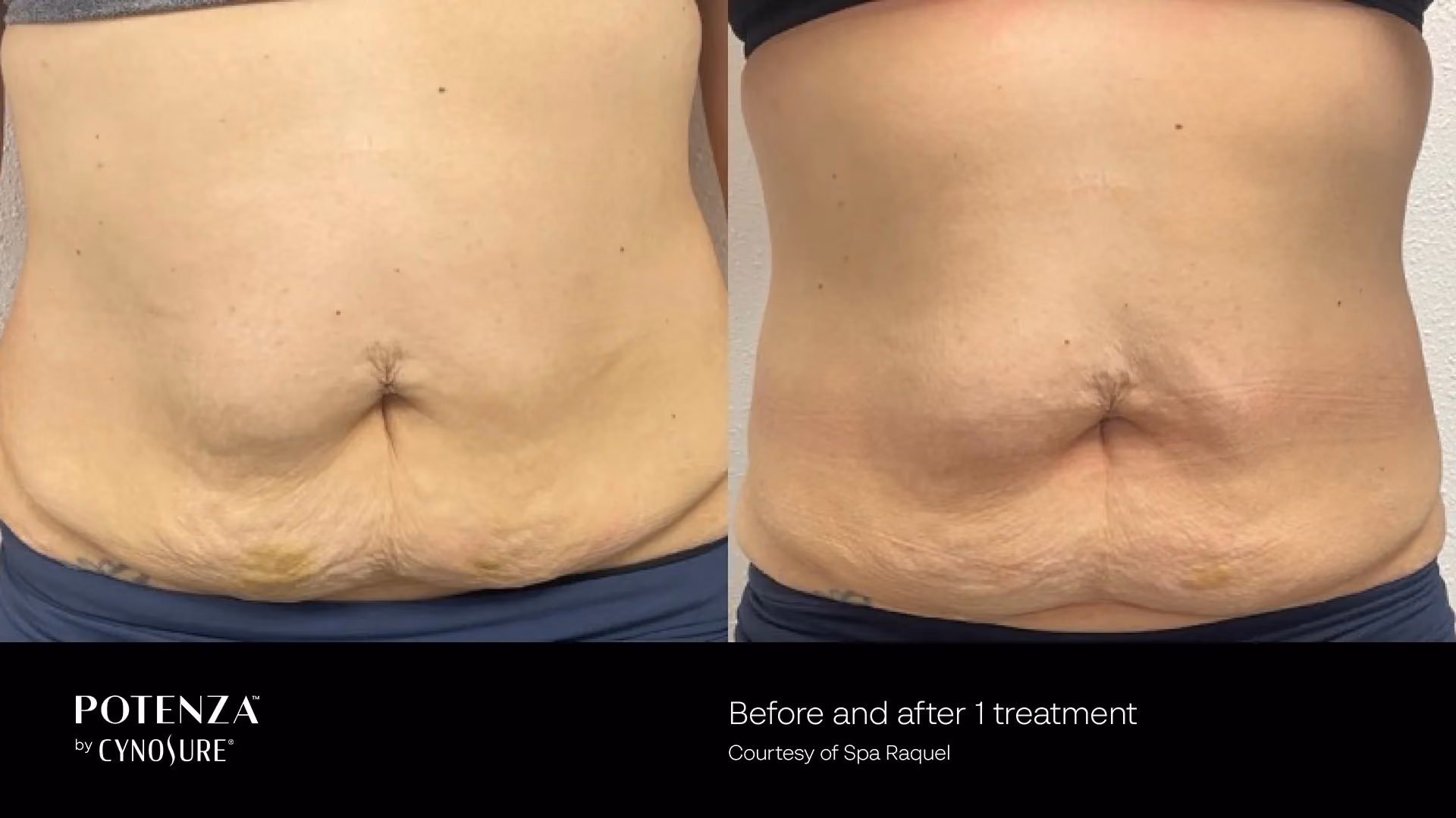 Before-and-after photos of the abdomen showing smoother, brighter skin after one professional skin rejuvenation treatment