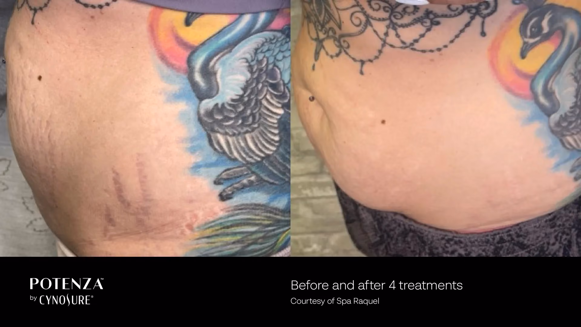 Before-and-after photos of the abdomen showing smoother, brighter skin after one professional skin rejuvenation treatment