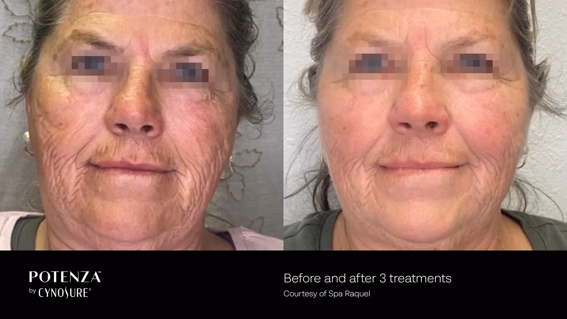 Before-and-after photos showing smoother, brighter skin after one professional skin rejuvenation treatment