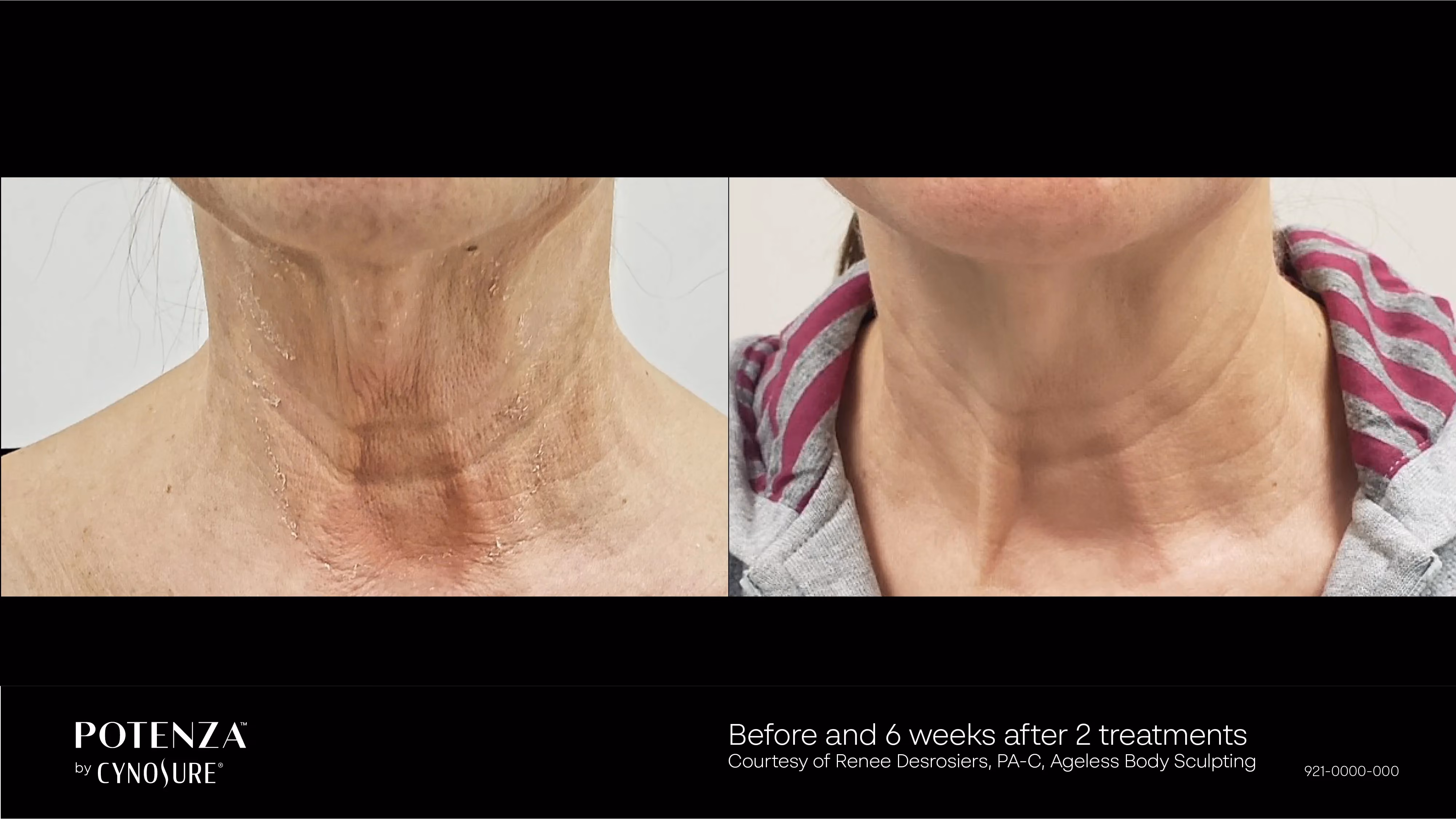 Before-and-after photos showing smoother, brighter skin after one professional skin rejuvenation treatment