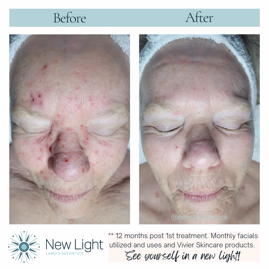 Image of before and after session treating Rosacea
