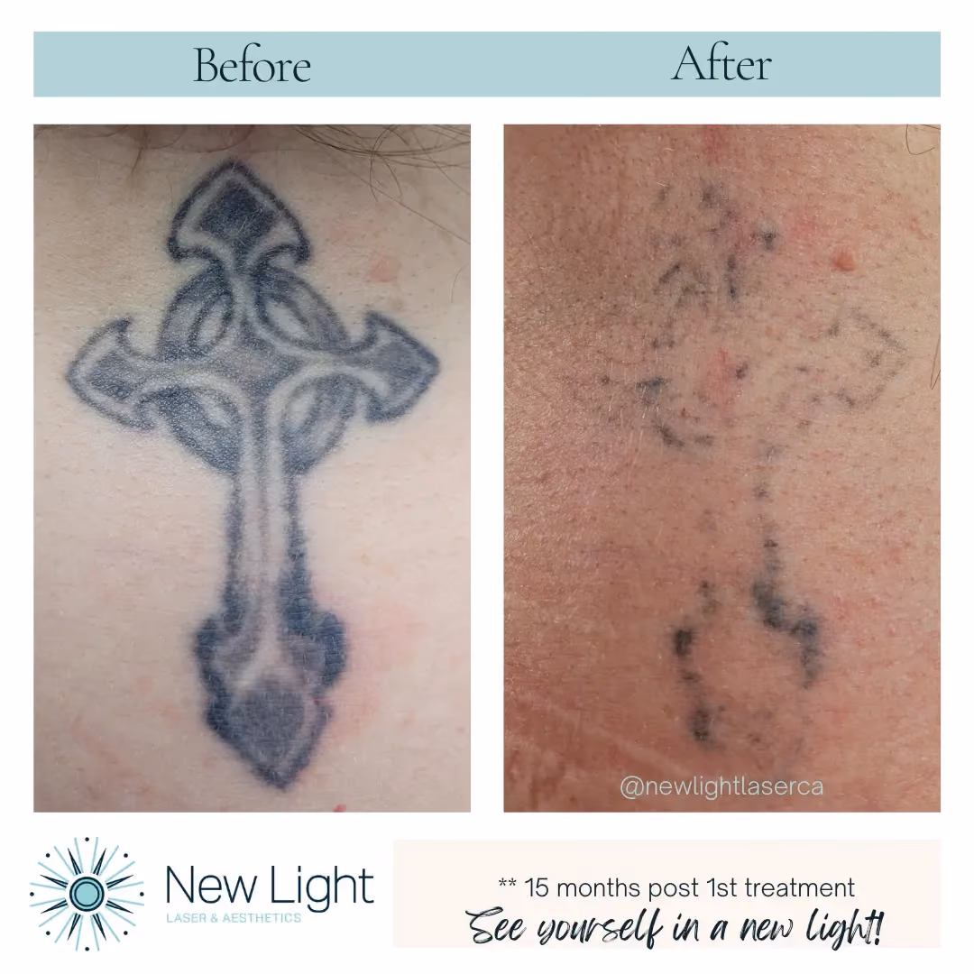 Before and after image of a tattoo removal session