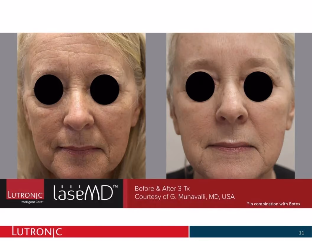 Before and after image after displaying client face with eyes covered