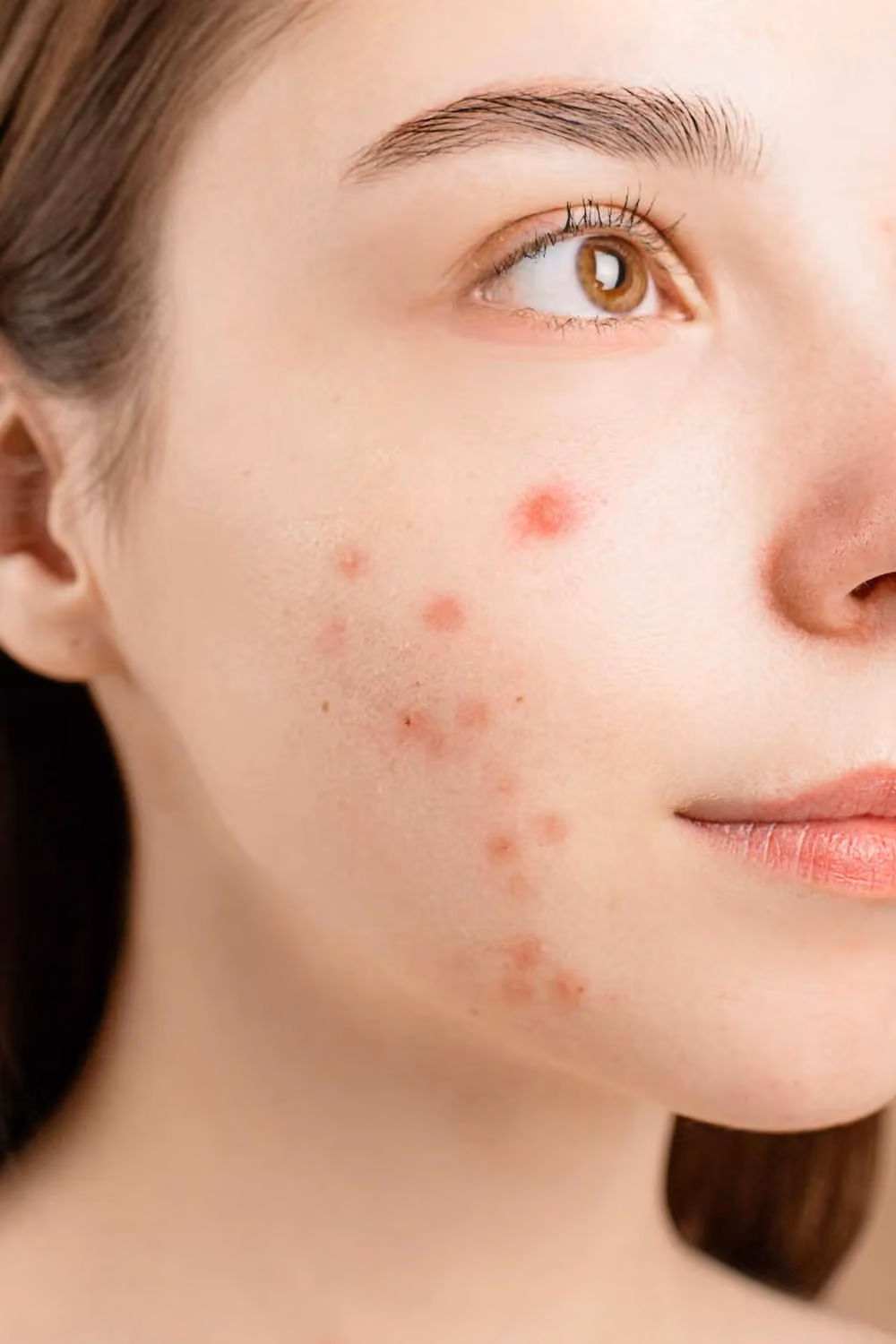 Image of a person showing acne on the face