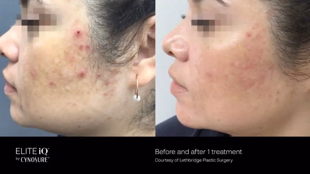 Before and after image showing the face of a woman