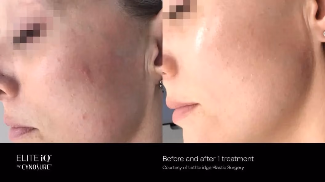 Before and after image showing the face of a woman