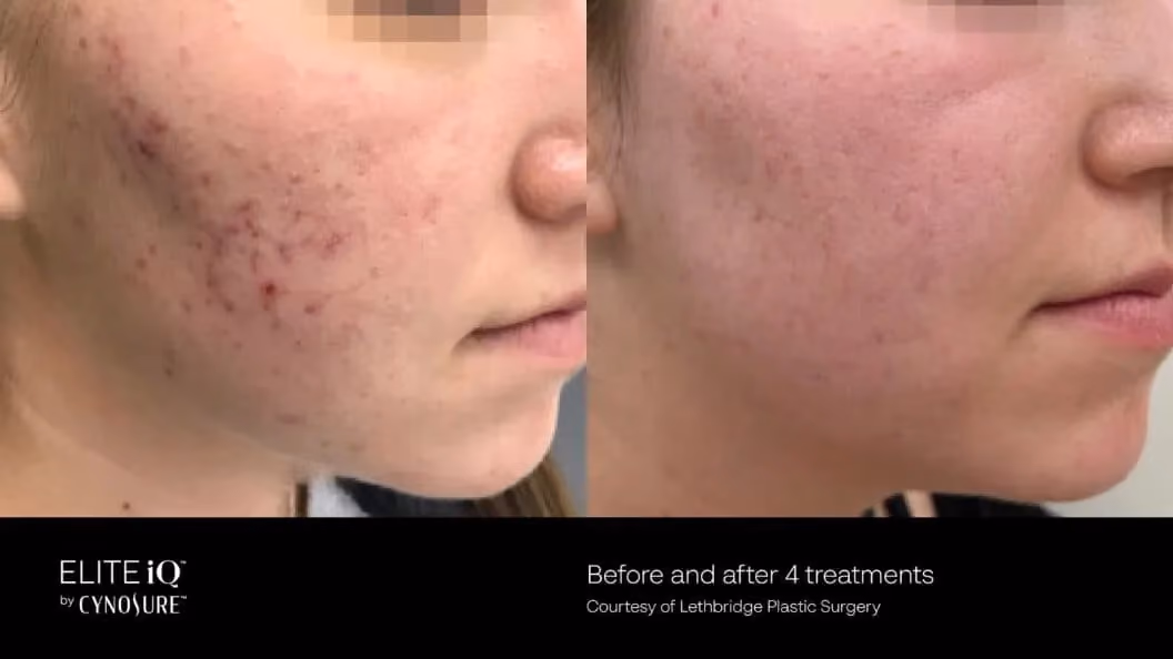 Before and after image showing the face of a woman