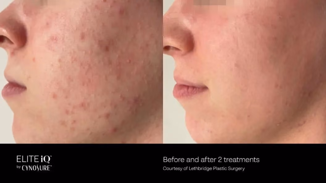 Before and after image showing the face of a woman