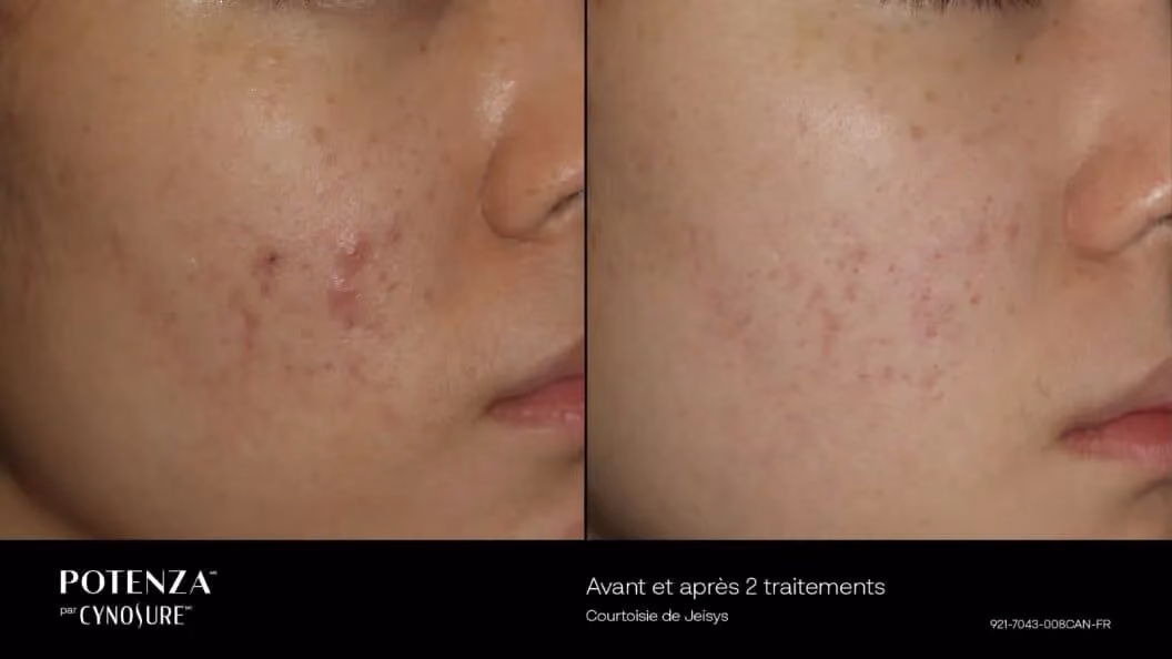 Before and after image showing the face of a woman