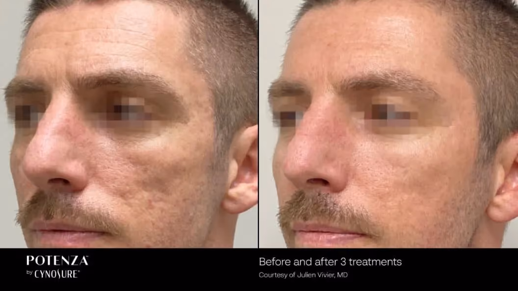 Before and after image showing the face of a man
