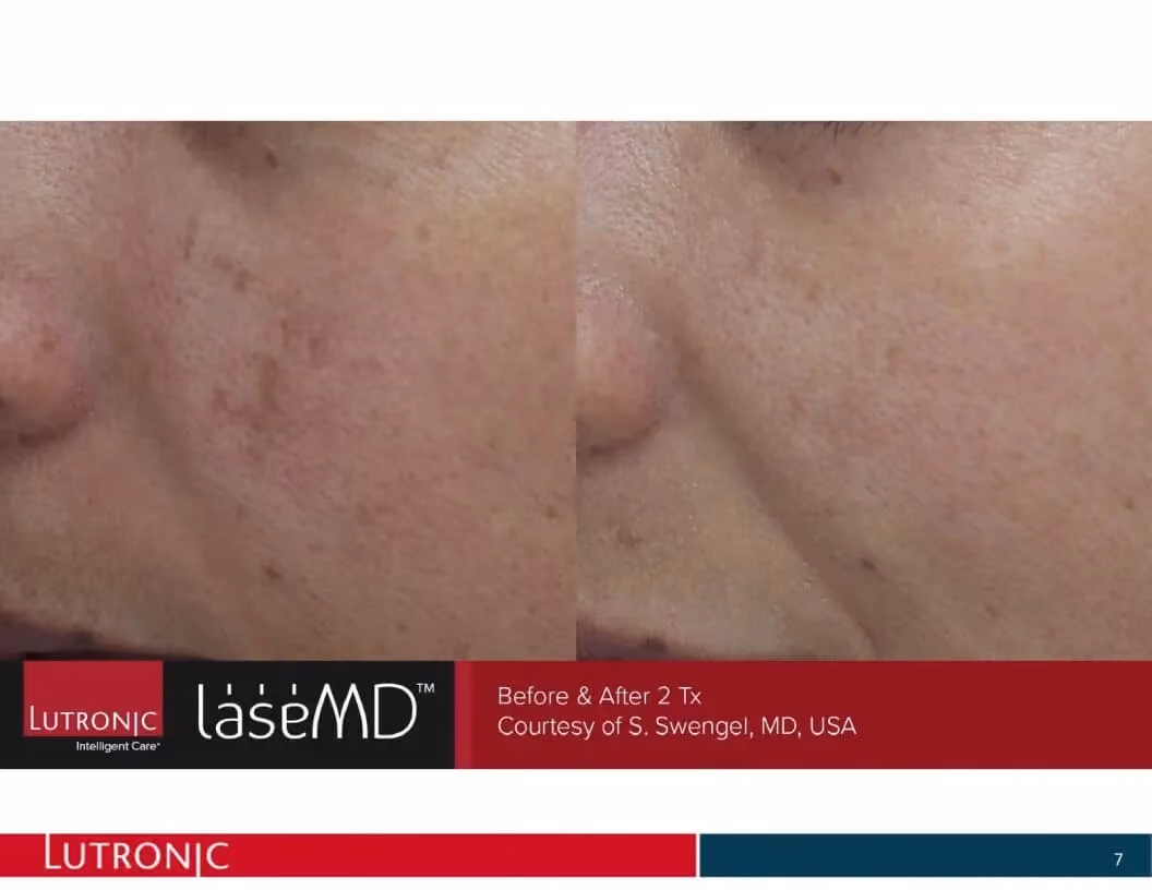 Before and after image after 2 treatments showing the cheeks