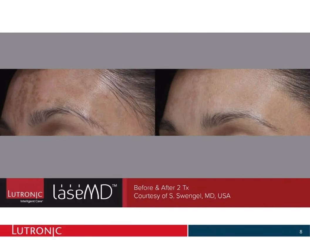 Before and after image showing the forehead